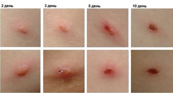 Ветряная оспа при беременности: в чем опасность заражения?