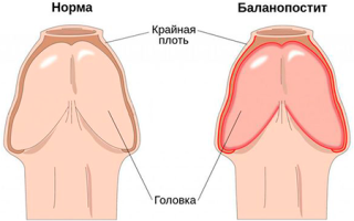 Какие виды и формы баланопостита существуют