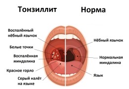 Опасности тонзиллита последствия хронического воспаления миндалин