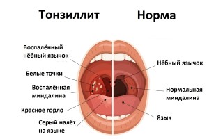 Опасности тонзиллита последствия хронического воспаления миндалин