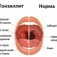 Опасности тонзиллита последствия хронического воспаления миндалин