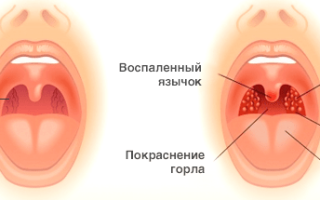 Причины боли в горле при глотании с одной стороны правая или левая сторона