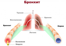 Симптомы бронхита признаки воспаления бронхов