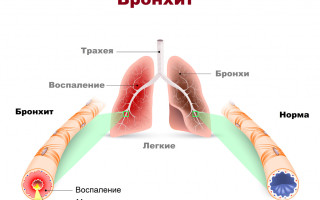 Симптомы бронхита признаки воспаления бронхов