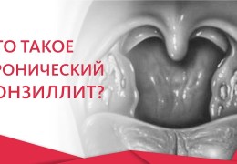 Тонзиллит симптомы болезни горла и методы лечения Видеоинструкция