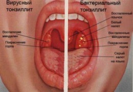 Острый тонзиллит симптомы и эффективное лечение болезни