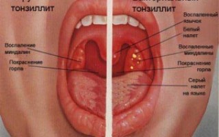 Острый тонзиллит симптомы и эффективное лечение болезни