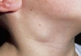 Увеличение лимфоузлов на шее причины и методы лечения воспаления