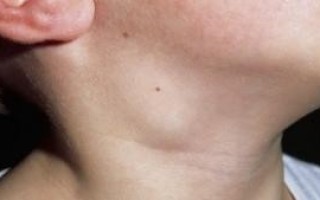 Увеличение лимфоузлов на шее причины и методы лечения воспаления