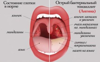 Осложнения после ангины симптомы и последствия у взрослых.3