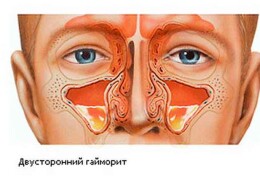 Сколько лечится гайморит и сколько времени проводят в больнице пациенты с этим заболеванием