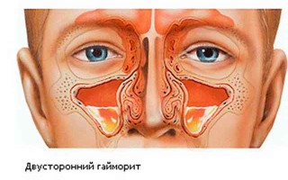 Сколько лечится гайморит и сколько времени проводят в больнице пациенты с этим заболеванием