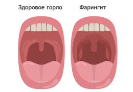 Фарингит у взрослых симптомы и лечение острой и хронической формы  Научные статьи