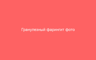 Гранулезный фарингит фото симптомы и лечение кашля у взрослых
