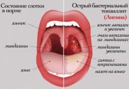 Осложнения после ангины симптомы и последствия у взрослых.2