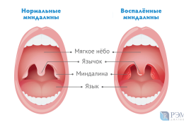 Может ли быть ангина без боли причины отсутствия боли при ангине