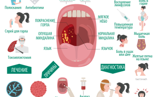 Фото и лечение фолликулярной ангины у взрослых эффективные методы