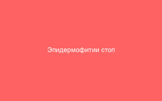 Эпидермофитии стоп признаки симптомы и методы лечения