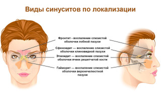 Синусит лечение симптомы и признаки болезни – полезная информация