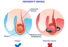 Перекрут яичка симптомы способы лечения и последствия