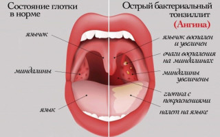 Что делать если болит горло голова болит при глотании но нет температуры