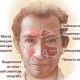 Полисинусит симптомы лечение острой и хронической формы причины и профилактика