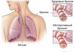 Сколько дней лечится бронхит у взрослых сроки выздоровления и прохождения