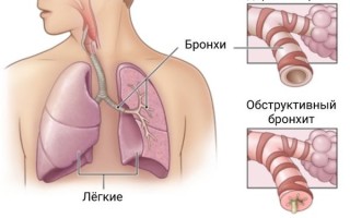 Сколько дней лечится бронхит у взрослых сроки выздоровления и прохождения