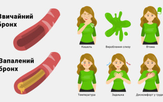 Остаточный кашель после бронхита у взрослых причины лечение рекомендации