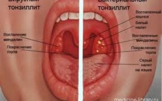 Тонзиллит и ангина различия и особенности болезней