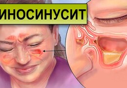 Риносинусит симптомы и лечение острой и хронической формы у взрослых