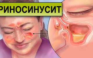 Риносинусит симптомы и лечение острой и хронической формы у взрослых