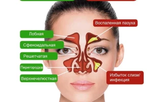 Полипозный синусит симптомы причины и эффективное лечение.1