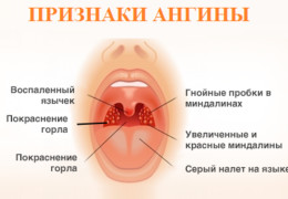 Стоматит и ангина причины симптомы и лечение стоматитной ангины