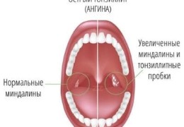 Назофарингит симптомы и лечение у взрослых