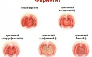 Фарингит симптомы причины и методы лечения