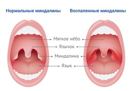 Тонзиллит симптомы и лечение у горла взрослых