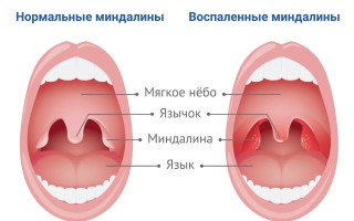 Тонзиллит симптомы и лечение у горла взрослых