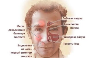 Полисинусит симптомы и лечение острой и хронической формы
