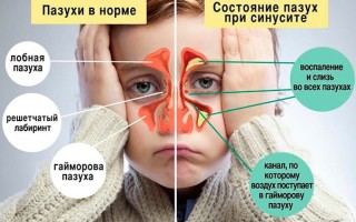 Может ли гайморит пройти сам причины симптомы и лечение