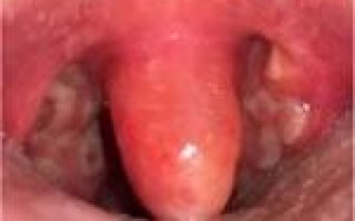 Что делать если воспалился и опух язычок в горле Способы лечения