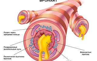 Острый бронхит симптомы лечение и профилактика  Научно-медицинский портал