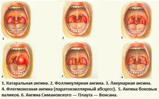 Флегмонозная ангина фото симптомы и лечение воспаления горла