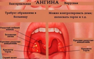 Фото ангины виды воспалений горла у детей и взрослых
