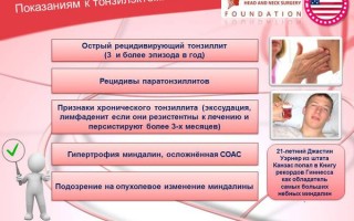 Профилактика хронического тонзиллита у взрослых эффективные методы и рекомендации