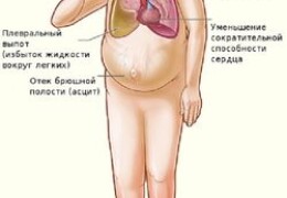 Сердечный кашель признаки симптомы и лечение кашля при сердечной недостаточности
