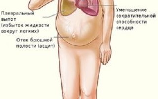 Сердечный кашель признаки симптомы и лечение кашля при сердечной недостаточности