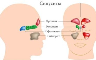 Хронический синусит у взрослых симптомы и методы лечения