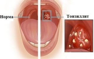 Тонзиллит заразен или нет Симптомы и способы защиты