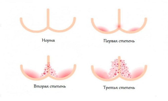 Опрелости - одно из показаний к применению средства